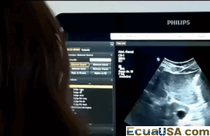 Epidemia Silenciosa: Los Cálculos Biliares se Convierten en la Principal Causa de Hospitalización en Ecuador