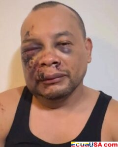 Salió a coger el bus para ir a trabajar, el ICE le disparó con pistola eléctrica, y despertó en el hospital con siete puntos en el labio y un derrame cerebral — sin poder hacerse la resonancia porque el grillete lo impide