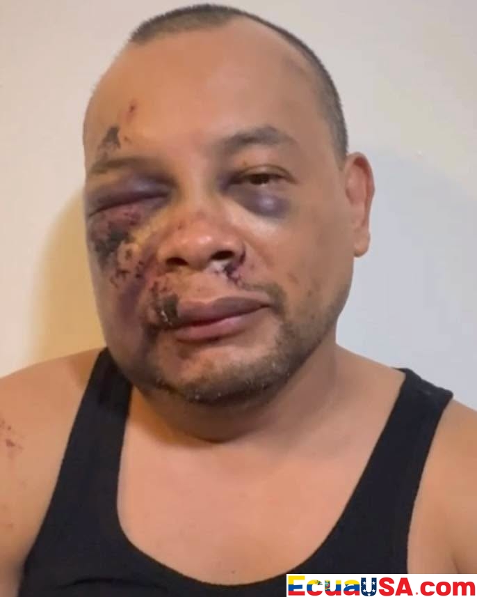 Salió a coger el bus para ir a trabajar, el ICE le disparó con pistola eléctrica, y despertó en el hospital con siete puntos en el labio y un derrame cerebral — sin poder hacerse la resonancia porque el grillete lo impide